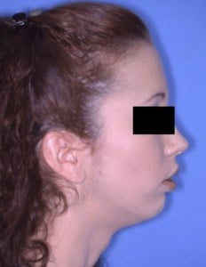 Before Jaw Surgery