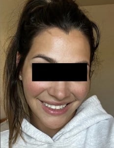 After Jaw Surgery