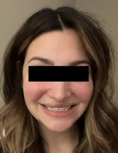 Before Jaw Surgery