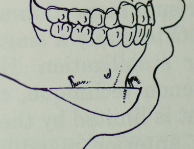 A hand-drawn medical sketch illustrating the profile of a human jaw and the positioning of teeth