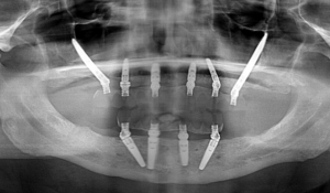 Panoramic dental X-ray showing multiple implants integrated into the upper and lower jaw