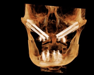 3D CT scan (CBCT) of a skull showing the length and trajectory of zygomatic implants extending into the cheekbones