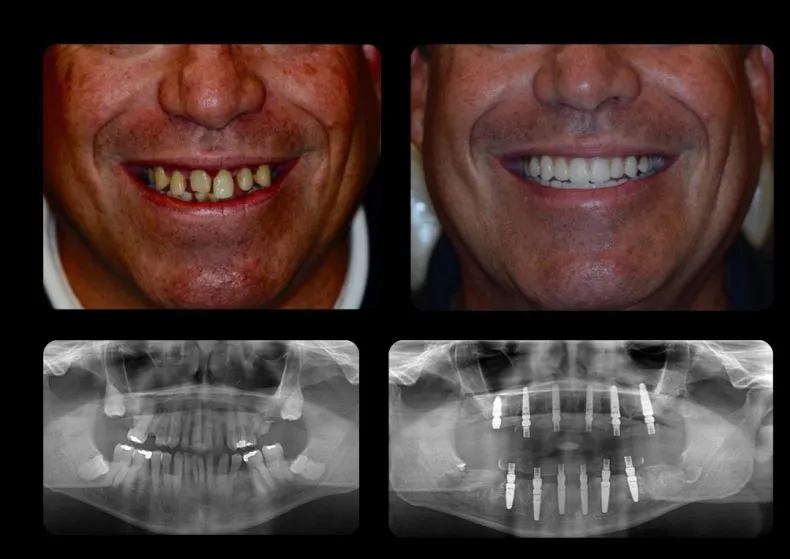 Comprehensive before-and-after collage featuring patient smiles and matching panoramic X-rays