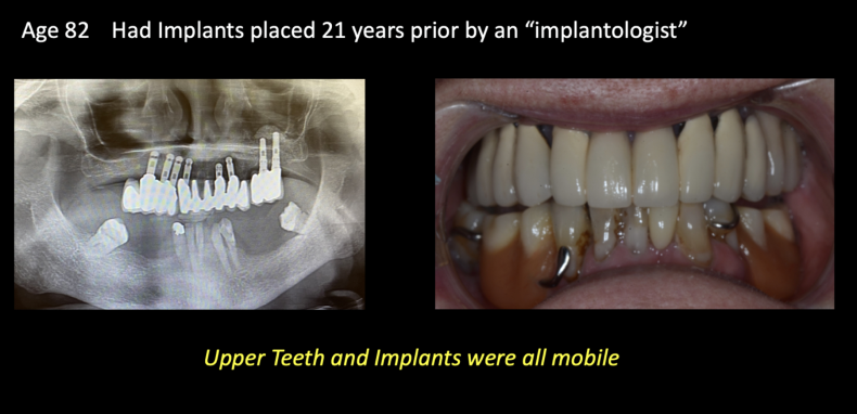 Case study of an 82-year-old patient showing mobile implants and the subsequent clinical correction