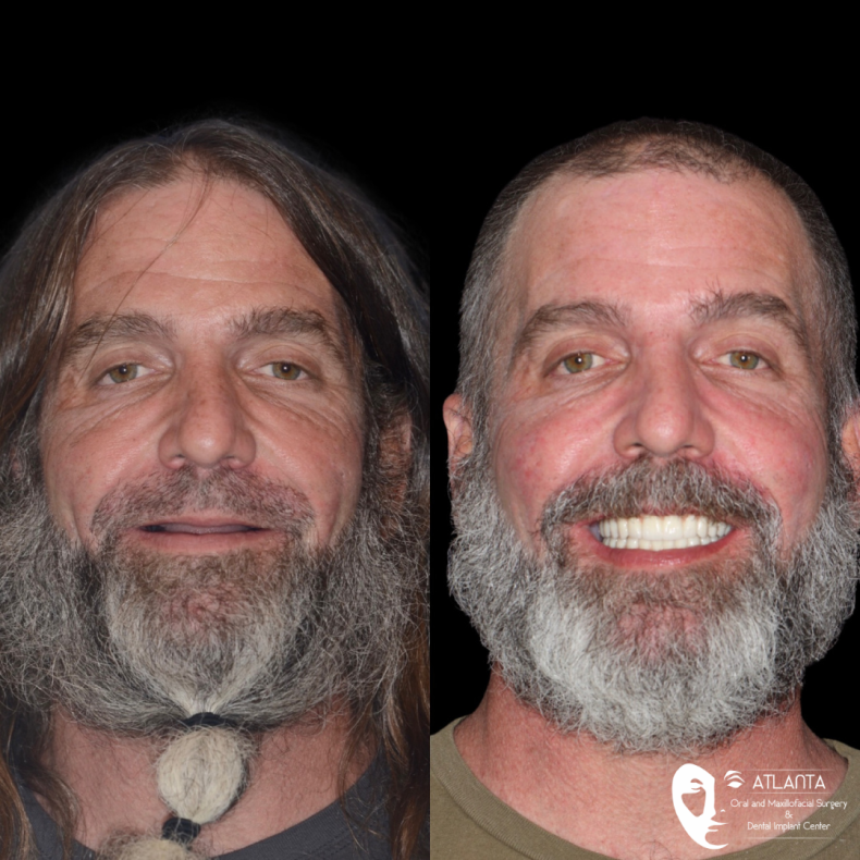 Before and After photos of patient, replacing teeth with All-on-X