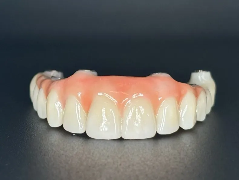 Close-up of a finalized, high-aesthetic porcelain dental bridge with natural gum-colored acrylic
