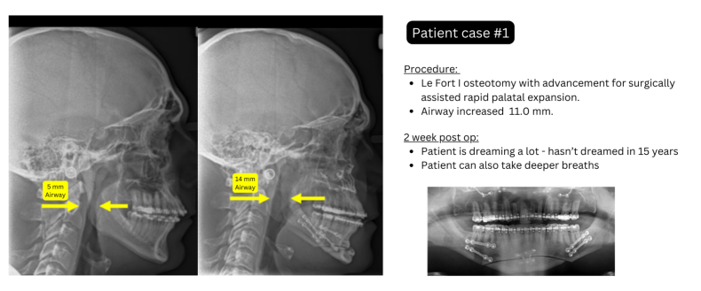 Lateral cephalometric X-rays for