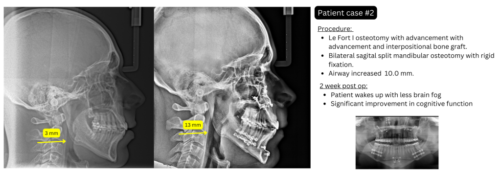 Lateral X-rays for
