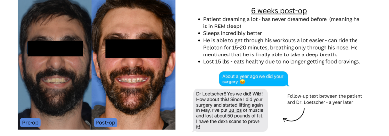 Before and after facial photos of a male patient with a 6-week post-op testimonial describing improved breathing, deeper sleep, and better workout recovery