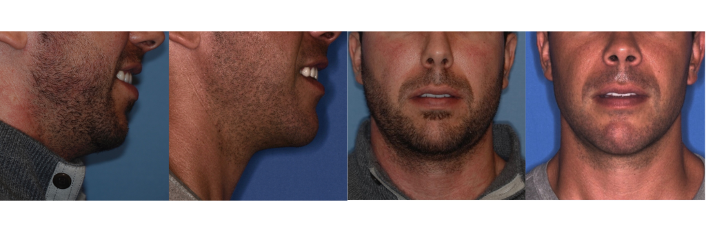 Four-panel profile and frontal view comparison of a male patient’s jaw alignment before and after orthognathic surgery