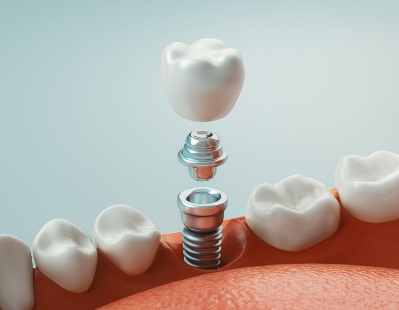 Dental Implants Illustration