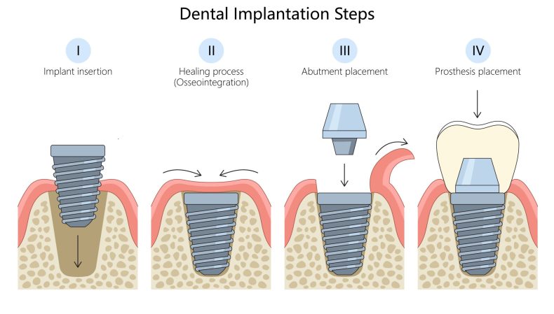 Dental Implants Illustration of the steps