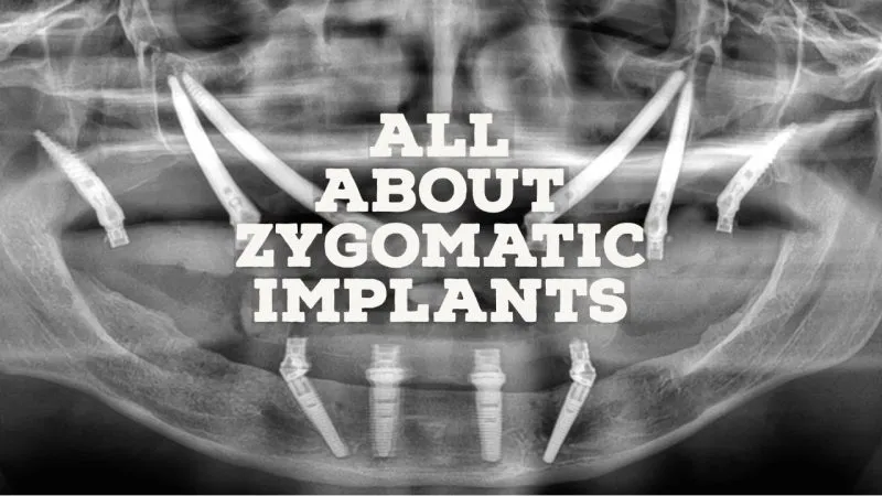 Everything you Need to know about Zygomatic Implant thumbnail