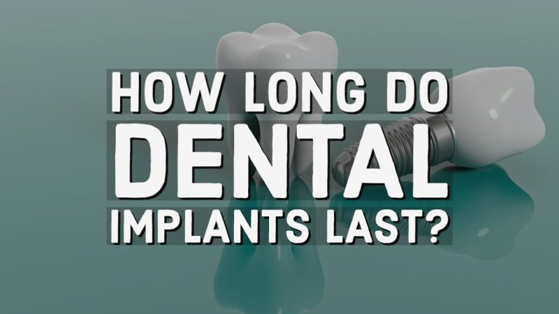 How Long Do Dental Implants Last thumbnail