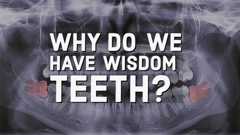 why do we have wisdom teeth thumbnail