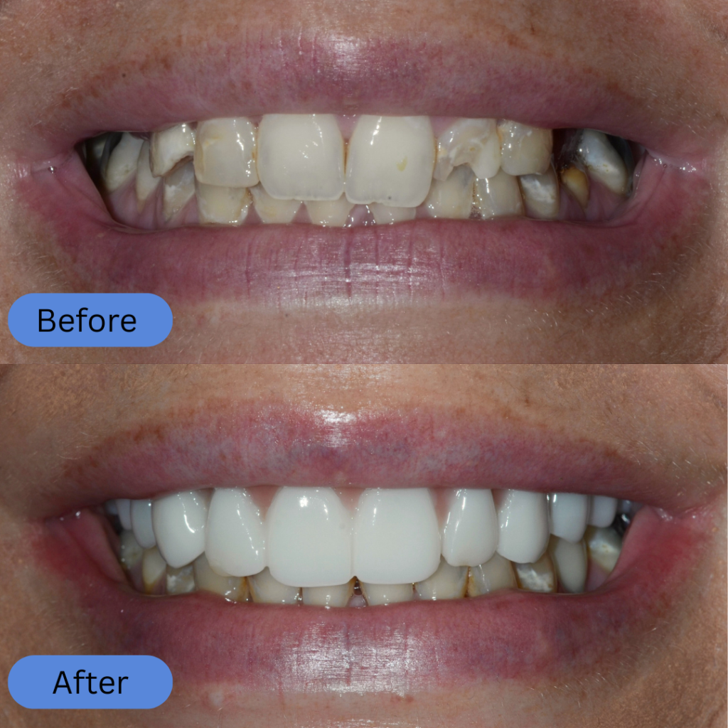 A feminine smile with slightly crooked and yellowed natural teeth. The