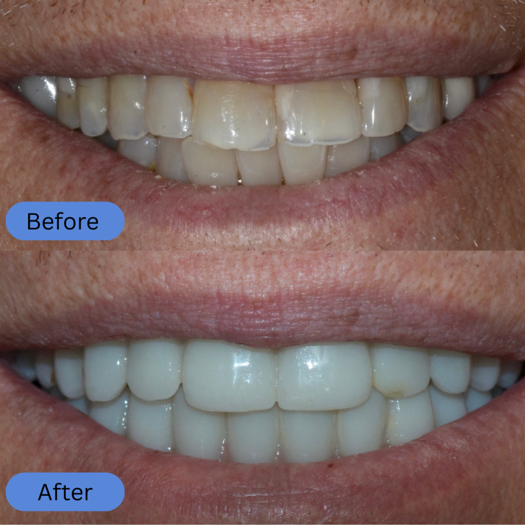 Comparison of upper teeth with worn edges and uneven color. The