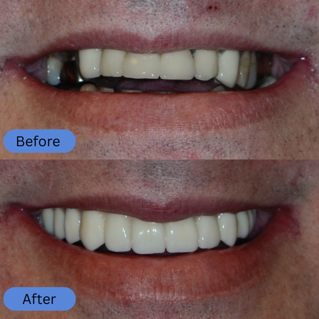 The before shows an old dental bridge with dark metal margins visible at the gum line. The after shows a modern, all-ceramic replacement that looks natural and white