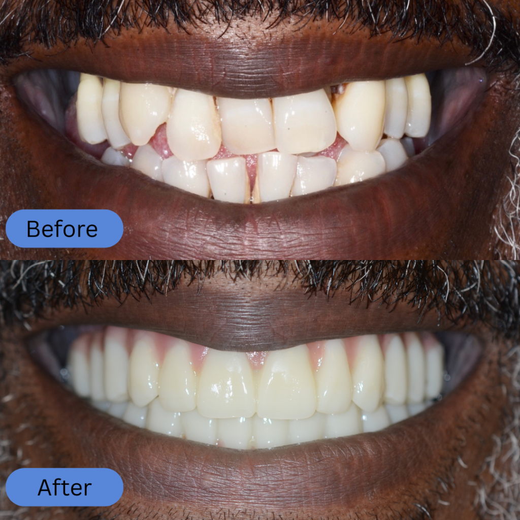 Close-up of a man's lower face. The before reveals chipped and unevenly spaced front teeth. The after shows a complete transformation with a full set of white, symmetrical dental crowns