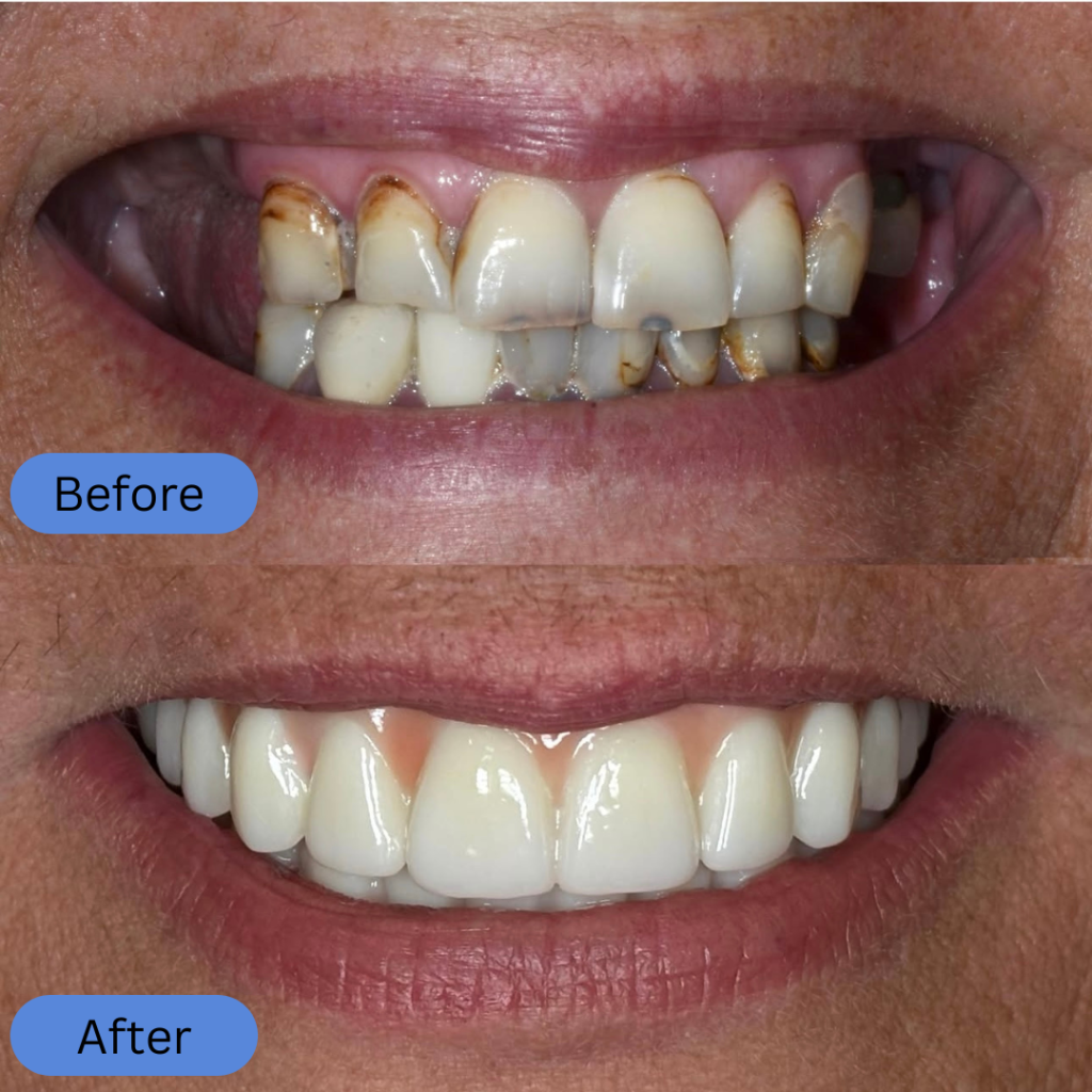 Close-up comparison of a smile. The