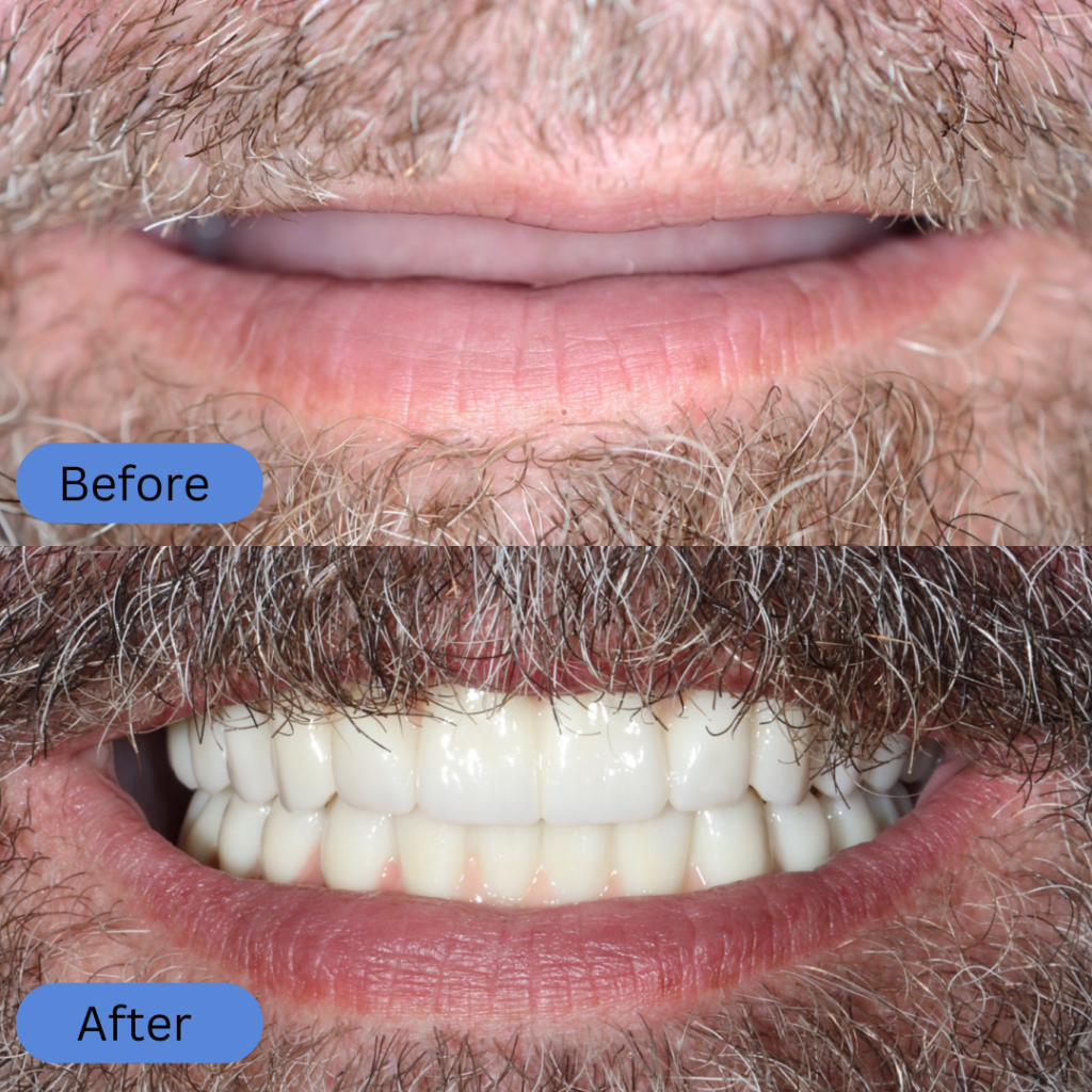 Comparison of a bearded man's mouth. The
