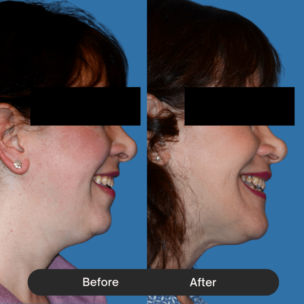 lear improvement in the jawline contour and a more balanced facial silhouette