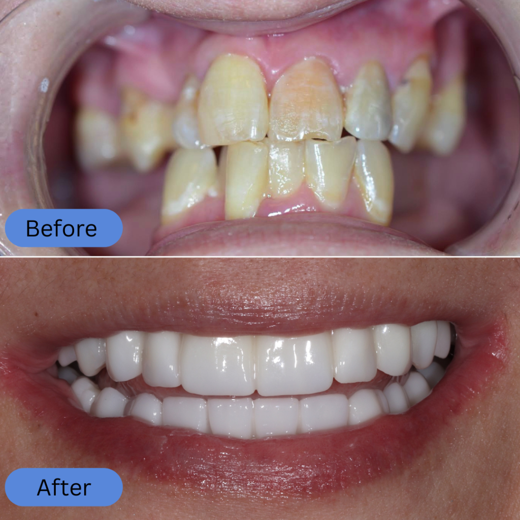 Close-up of crowded and discolored natural teeth in the