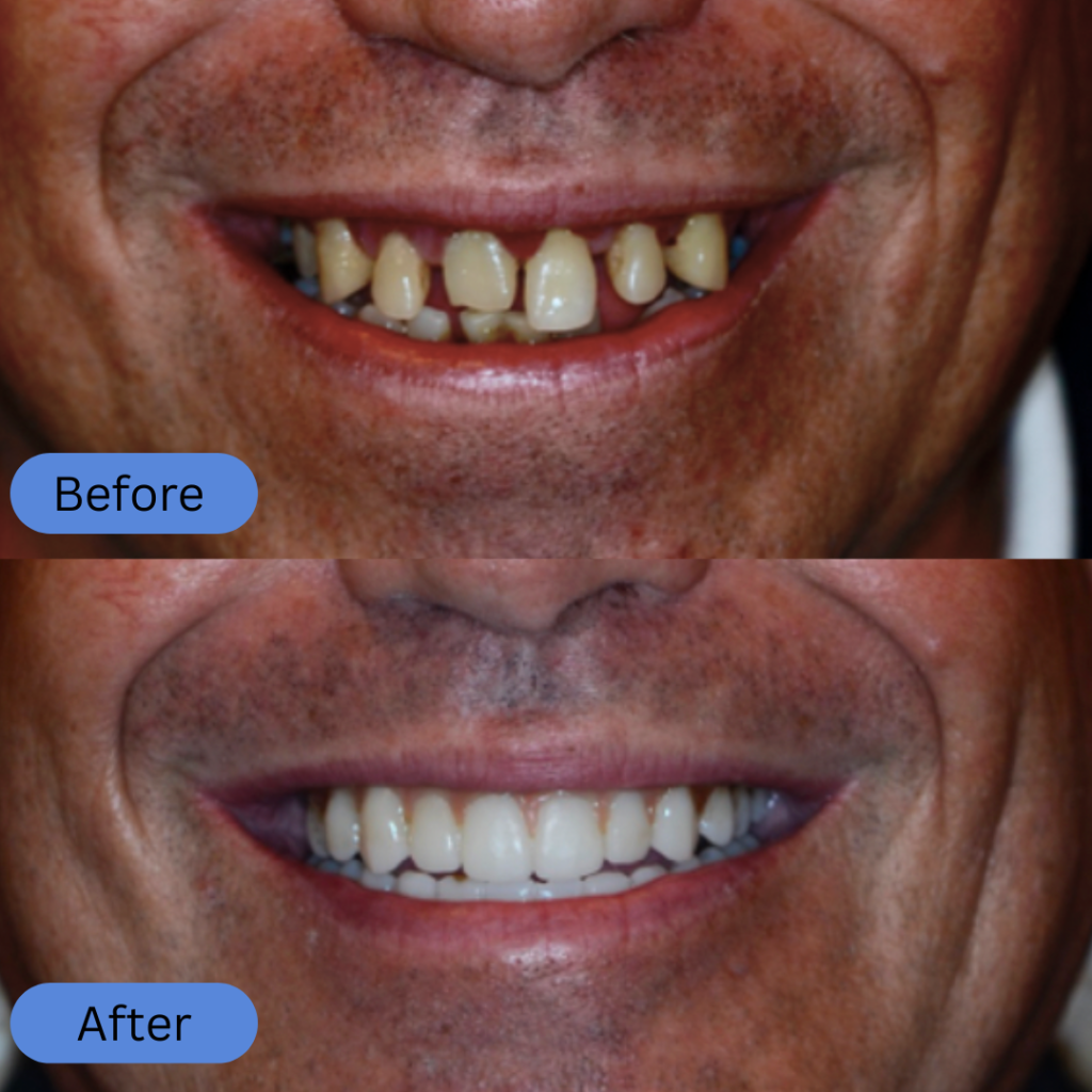 A man’s face while smiling. The