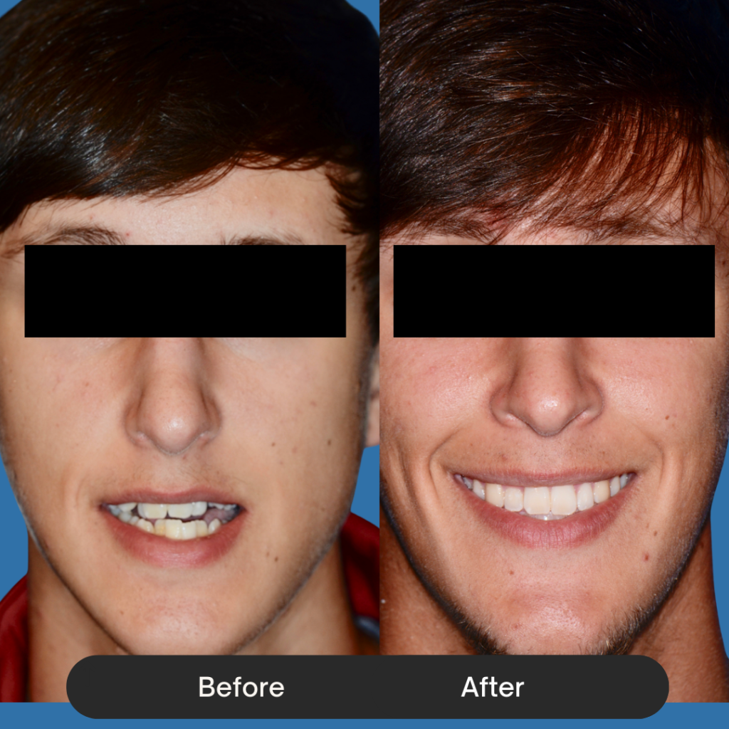 Frontal view of a young man. The before shows an uneven smile with visible crowding and a slight jaw asymmetry. The after shows a broad, symmetrical smile with perfectly aligned white teeth and a more balanced facial structure