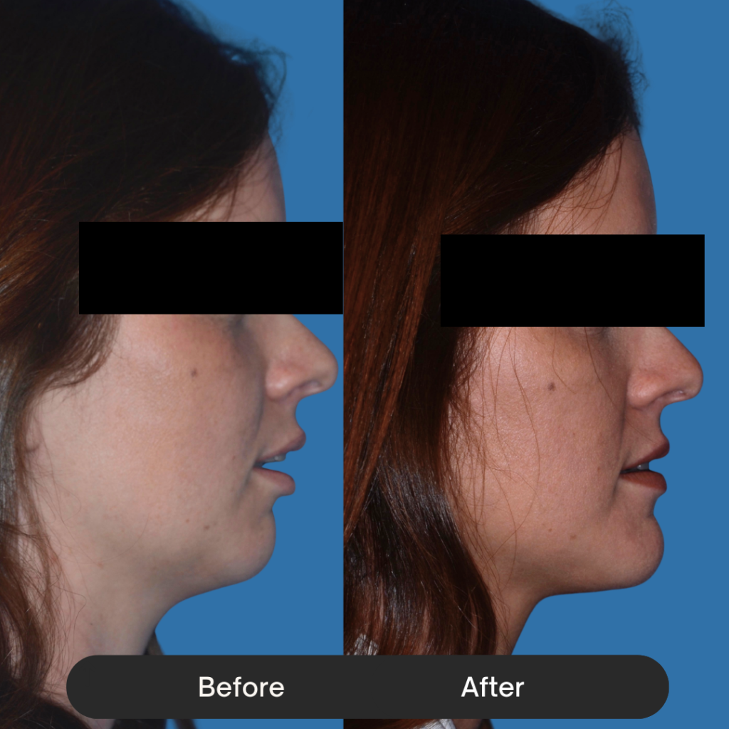 Side profile of a woman with dark hair. The before shows a lack of definition between the chin and the neck due to a recessed mandible. The after shows a sharpened jawline and a more prominent chin after mandibular advancement surgery