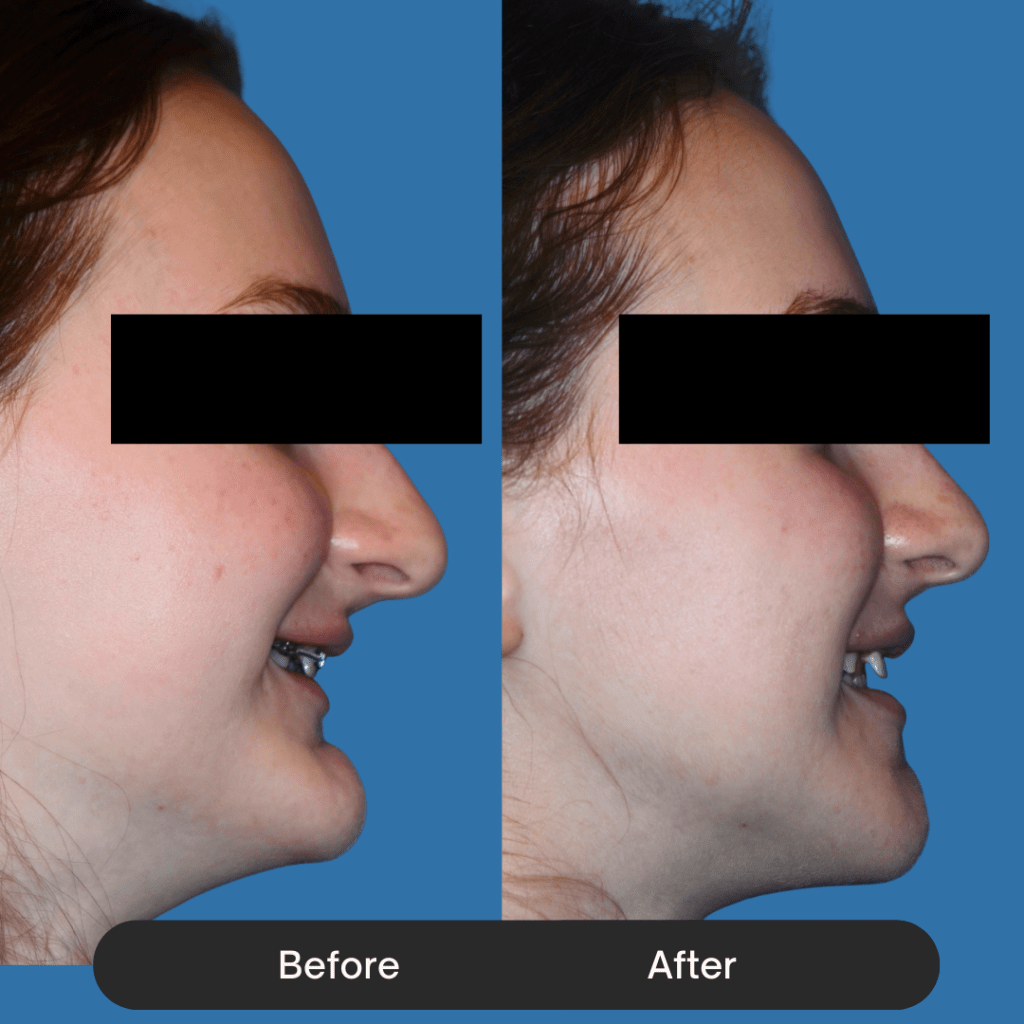 Side profile focusing on an underbite correction. The before shows the lower jaw and teeth protruding beyond the upper lip. The after shows the lower jaw repositioned backward (or upper jaw forward), creating a standard profile alignment and improved lip posture