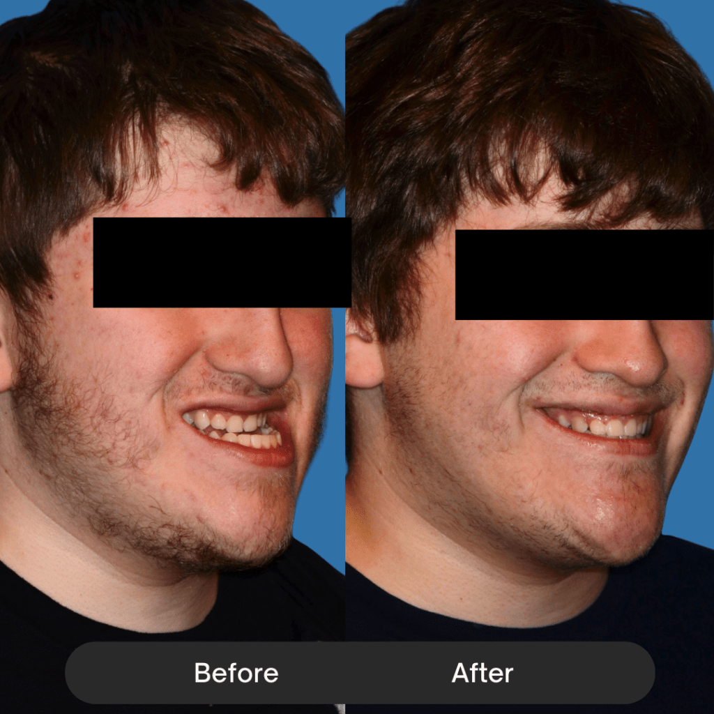 Three-quarter profile of a young man. The before shows a recessed lower jaw that affects the smile's appearance. The after shows a broader, more confident smile with better skeletal support