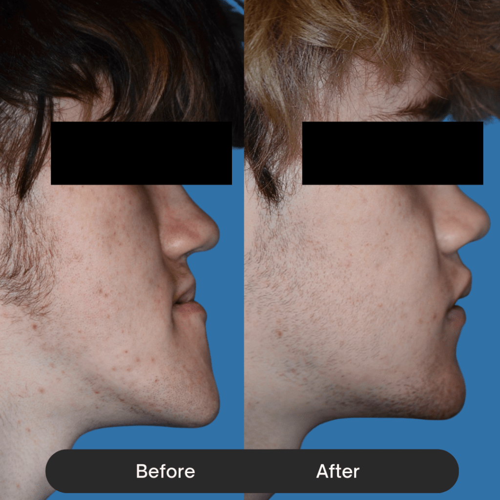 Extreme profile view of a young man with a severe underbite in the 