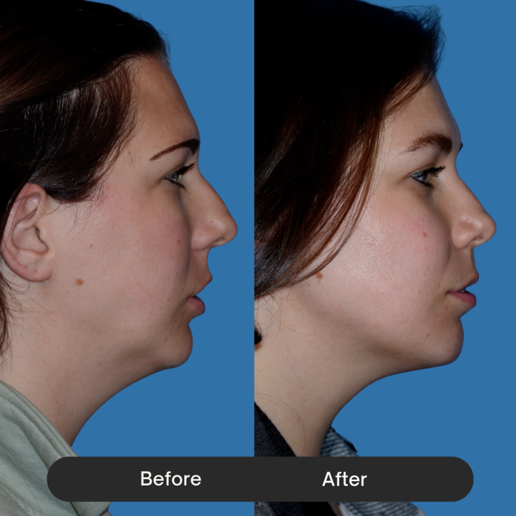 Profile view of a woman. The 