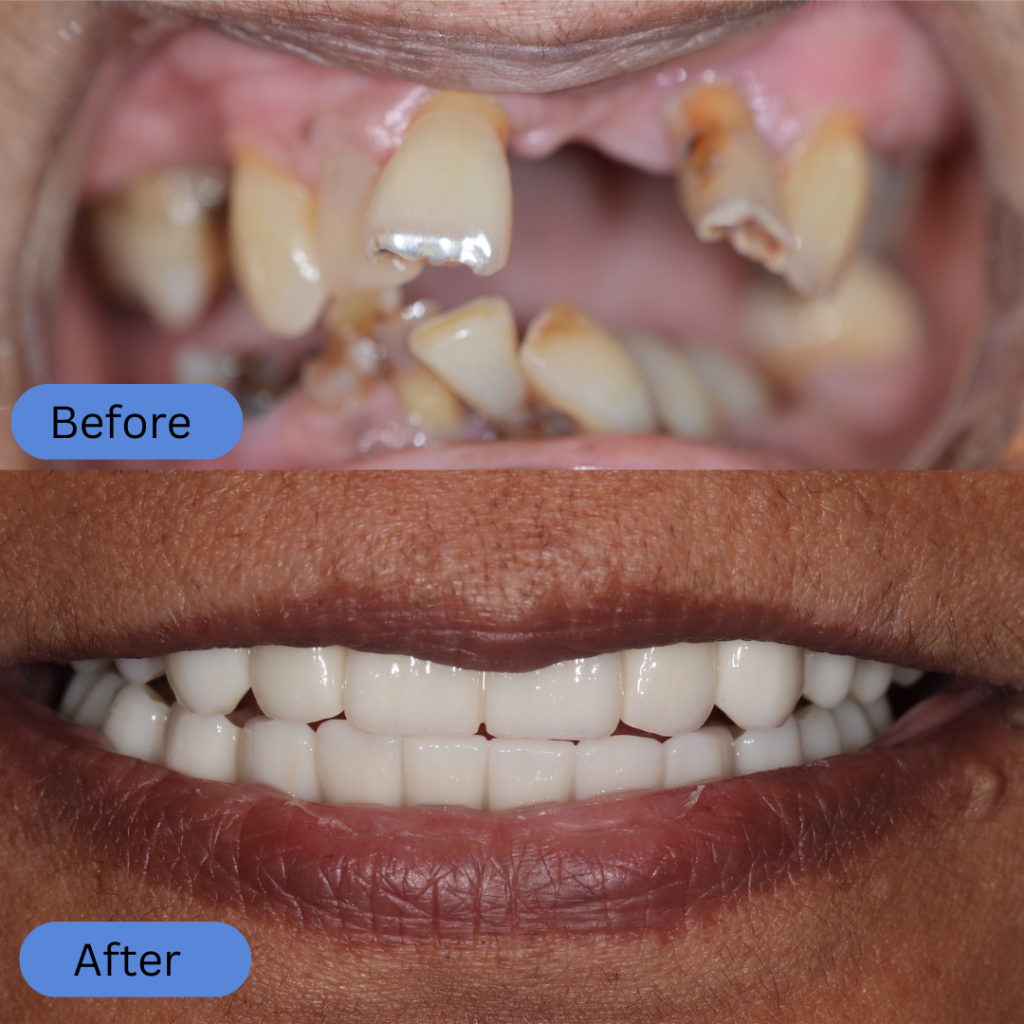 Comparison showing a mouth with missing, broken, and heavily decayed teeth in the