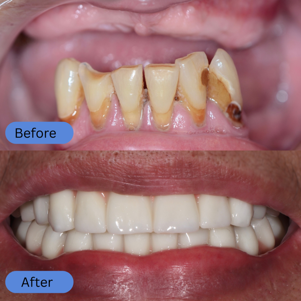 Transformation of severe periodontal issues. The