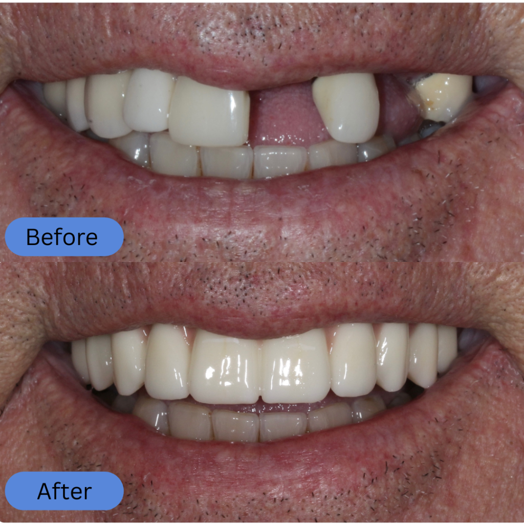 Before image highlighting missing front teeth and gaps. The after image shows the result of dental implants or bridges, restoring a full and straight upper arch